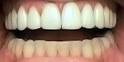 smile-before-11_enhanced_sharpen